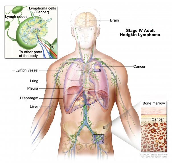 cancerul sistemului limfatic)