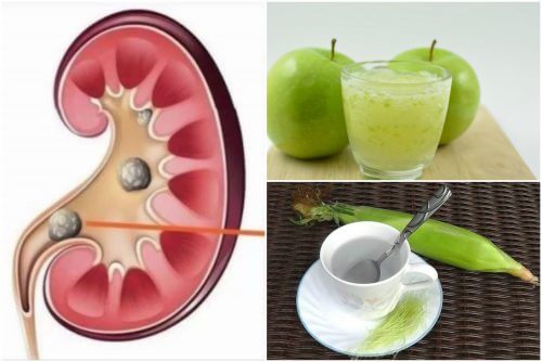 Pietre la rinichi: 6 remedii naturale - Doza de Sănătate