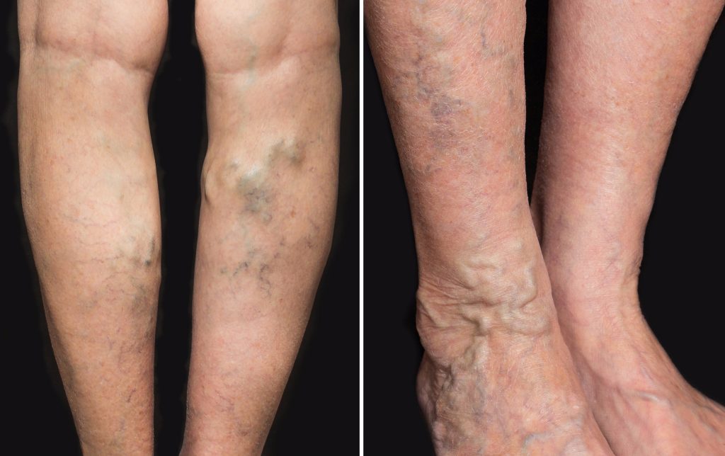 tumora dupa operaia de pe picior varicoza varicoza pe picioare la care medicul