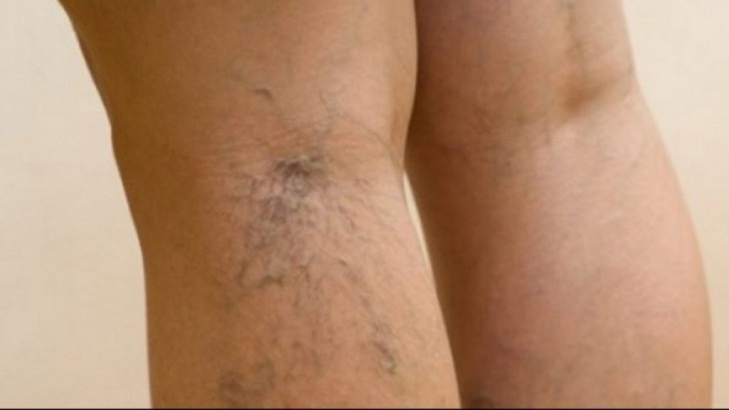 tratamentul tradițional al venelor varicoase box în timpul picioarelor varicoase