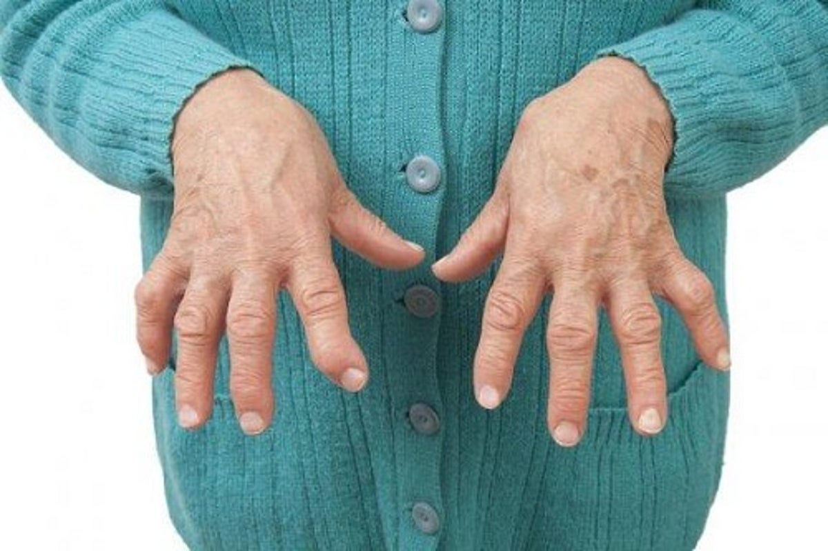 artrită autoimună