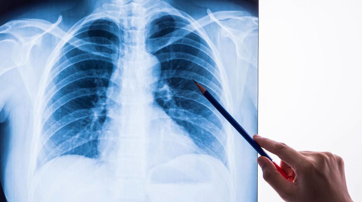 Semne de pneumonie: ce să faci cand apare boala și când trebuie sa mergi un medic