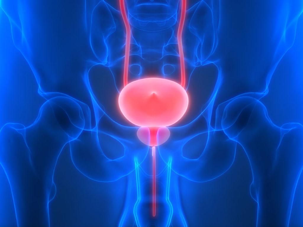 Cancerul vezicii urinare: simptome și cauze