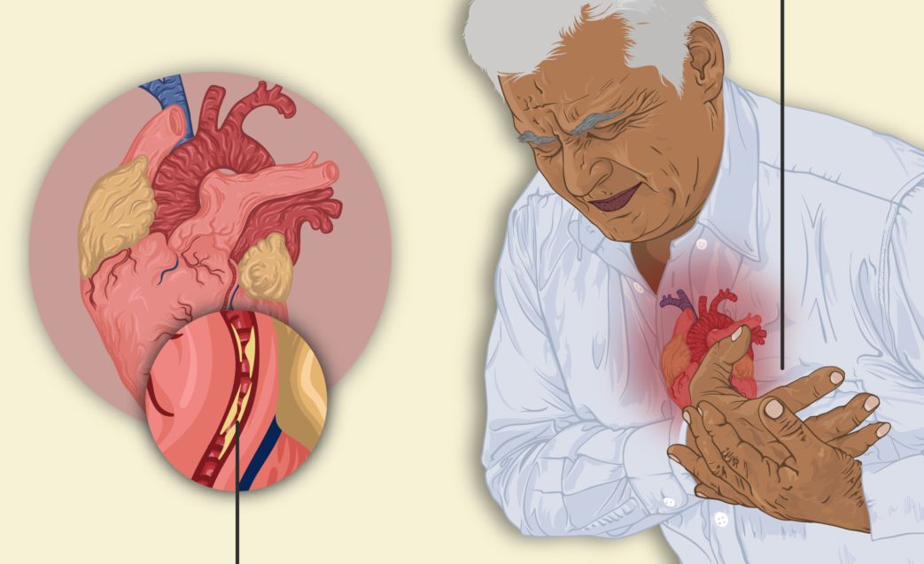 Ce simptome ai când faci infarct – 5 situații care atrag atenția