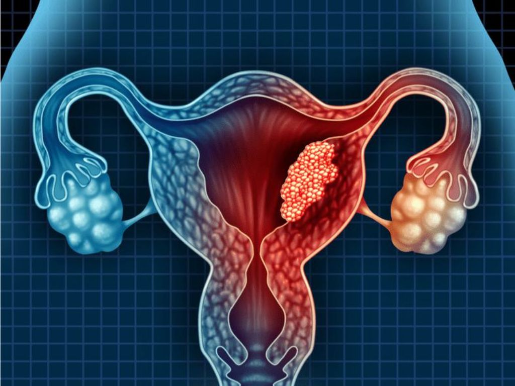tratamentul uterin al papilomavirusului uman uterin)