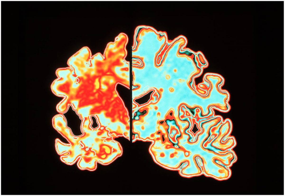 Noi cercetări arată că există, de fapt, trei subtipuri diferite ale maladiei Alzheimer