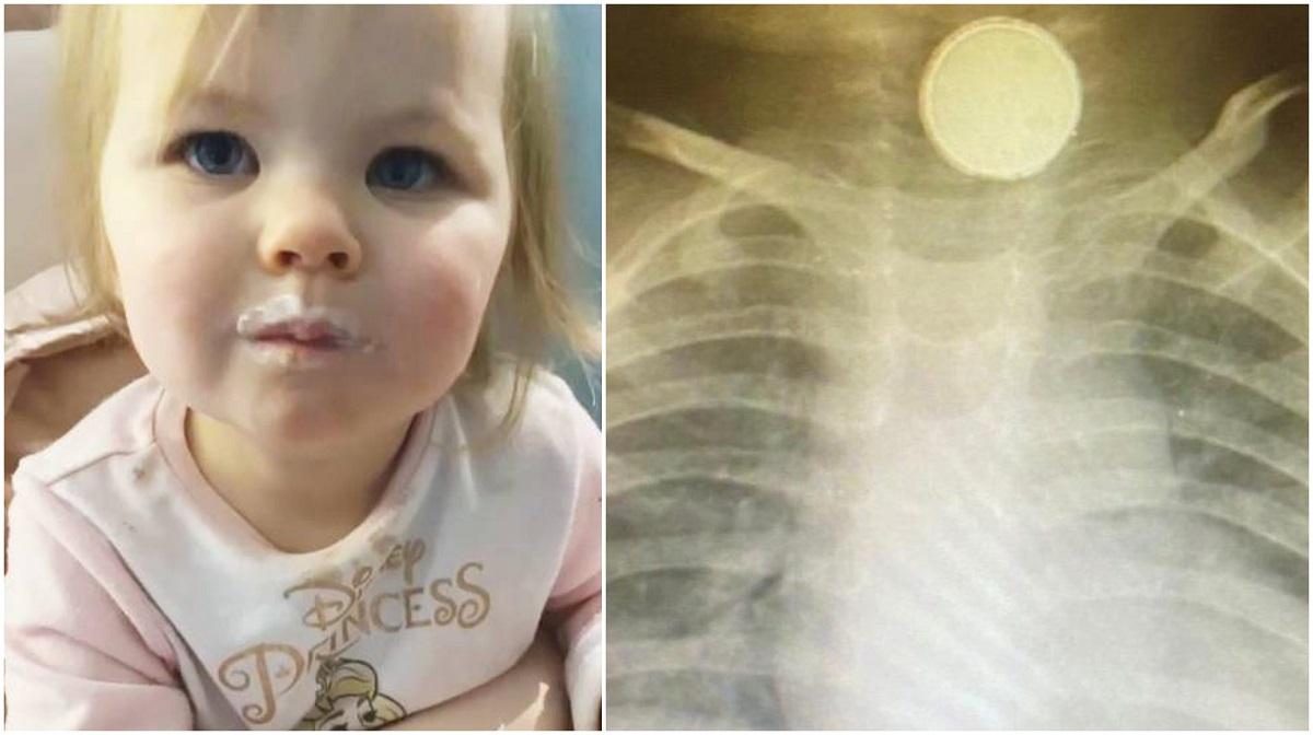 Un bebeluş a stat 4 luni cu baterie în gât. Medicii au crezut că are amigdalită