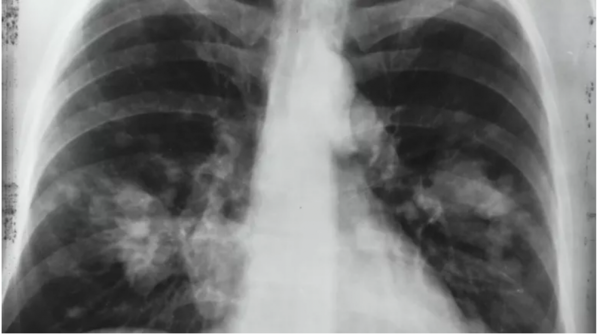 Cine este expus riscului de COVID lung? Ce știu oamenii de știință până acum?