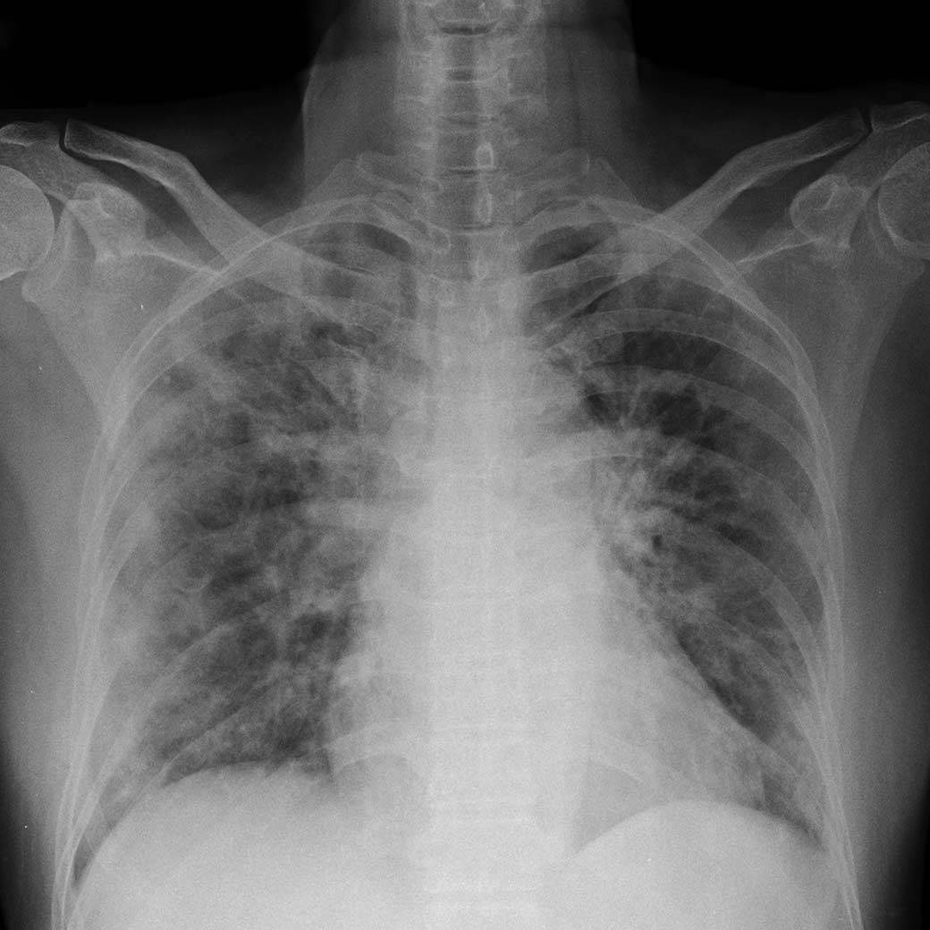 Covid-19: Formele severe provoacă simptome persistente?