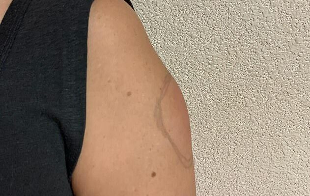 „Braţ Covid”, efectul advers rar apărut după administrarea vaccinului Moderna. Ce spun medicii