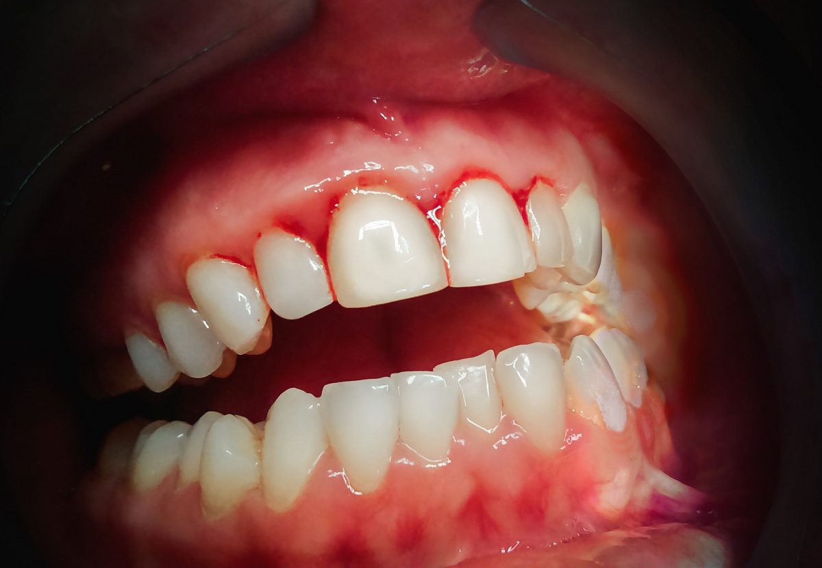 Vă sângerează gingiile? Folosiți vitamina C!