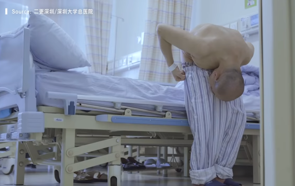 Un chinez a stat îndoit 28 de ani. Medicii au reuşit să-i îndrepte coloana după o operaţie chirurgicală complexă. Cum arată bărbatul acum – FOTO/ VIDEO