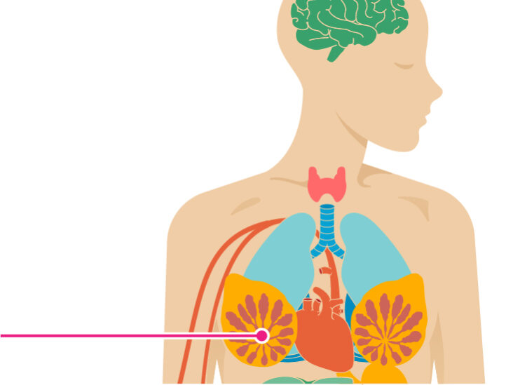Cele mai cunoscute simptome de cancer la sân