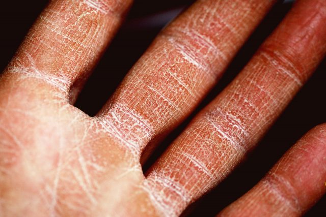 Diabet: Simptome diferite la bărbaţi şi femei