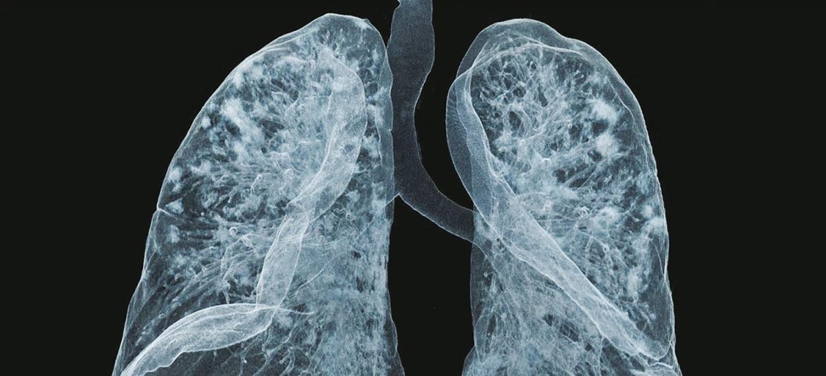 Covid lung: asimptomatici în momentul infecției, acești pacienți suferă de sechele întârziate