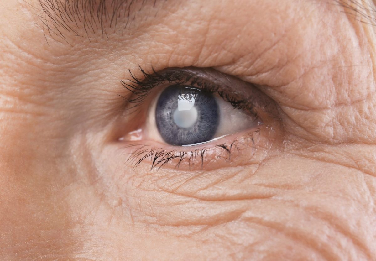 4 concepții greșite despre cataractă
