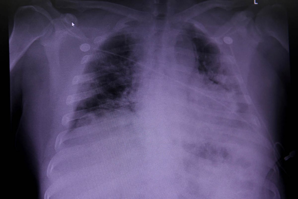Covid lung: pacientii ar avea un risc crescut de deces in decurs de 6 luni