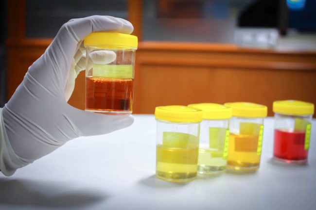 Leucocite mărite în urină: Cum pot fi depistate și tratate infecțiile urinare