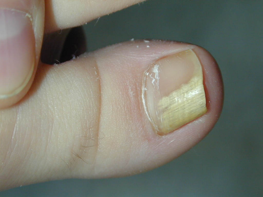 unghie albă cu ciuperca unghiei
