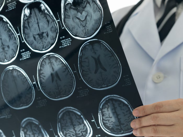 Ai avut covid? Posibil să suferi de demență sau un accident vascular cerebral