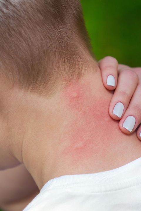 Remedii anti înțepături de insecte. Când trebuie să mergi la Urgențe
