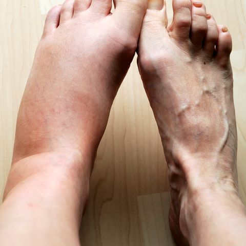 Suferi de picioare umflate? Uite cele mai comune 8 cauze