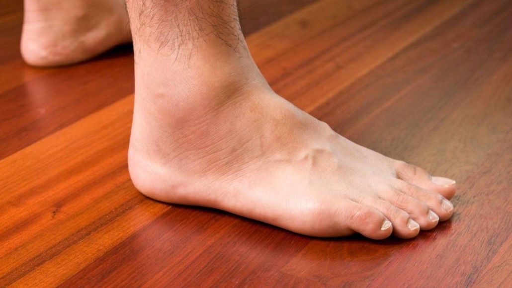 Picioare umflate - cauze, prevenire si tratament