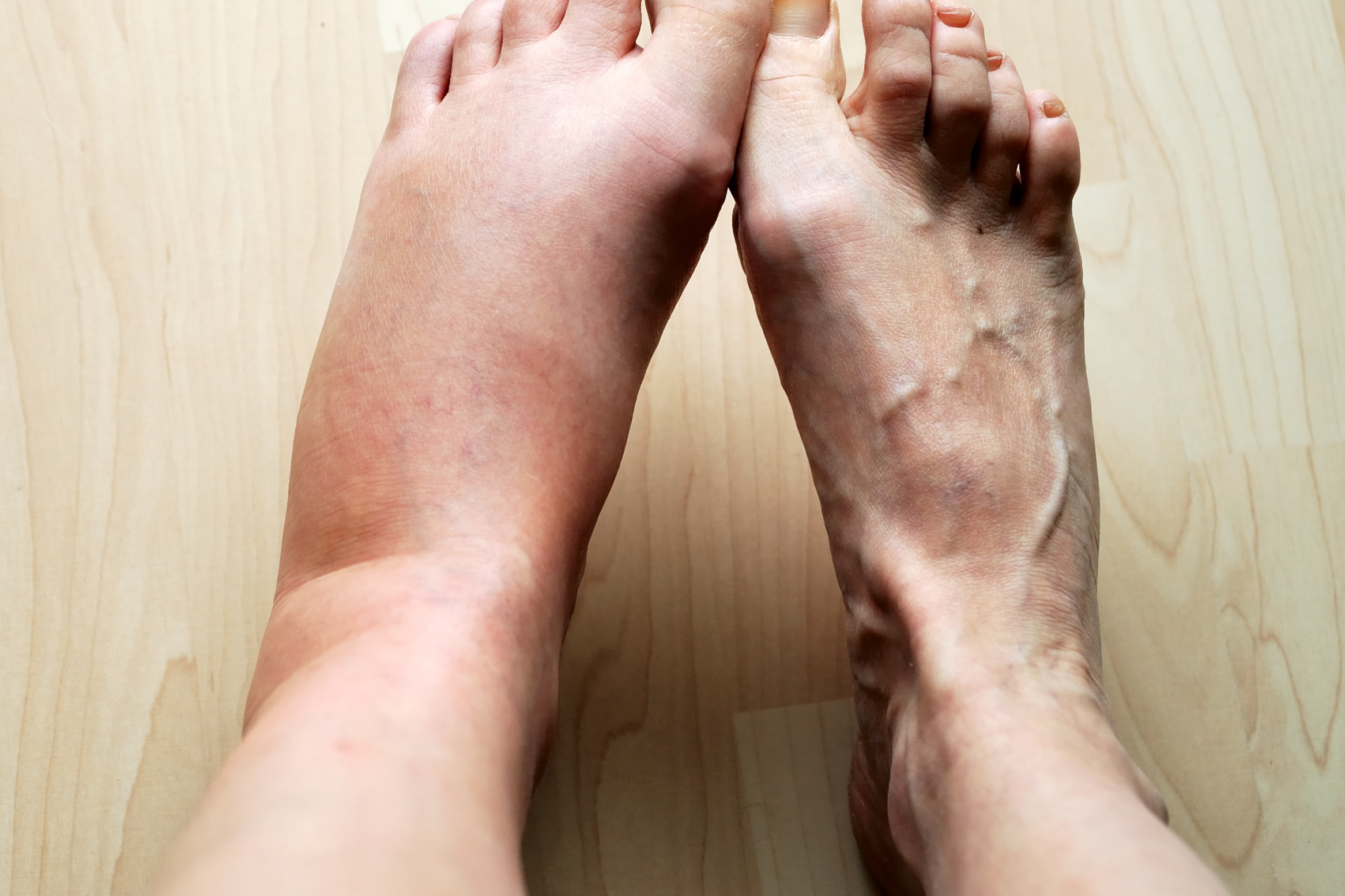 Picioare umflate: cauze, remedii, preventie, riscuri