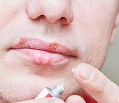 Cremă pentru herpes: Soluții medicale pentru a scăpa rapid de problemă