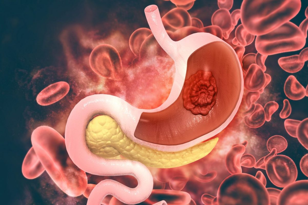 Helicobacter Pylori: Tratament naturist cu rezultate spectaculoase