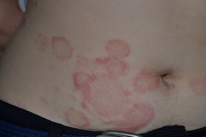 Herpes circinat: Care sunt simptomele și cum se tratează