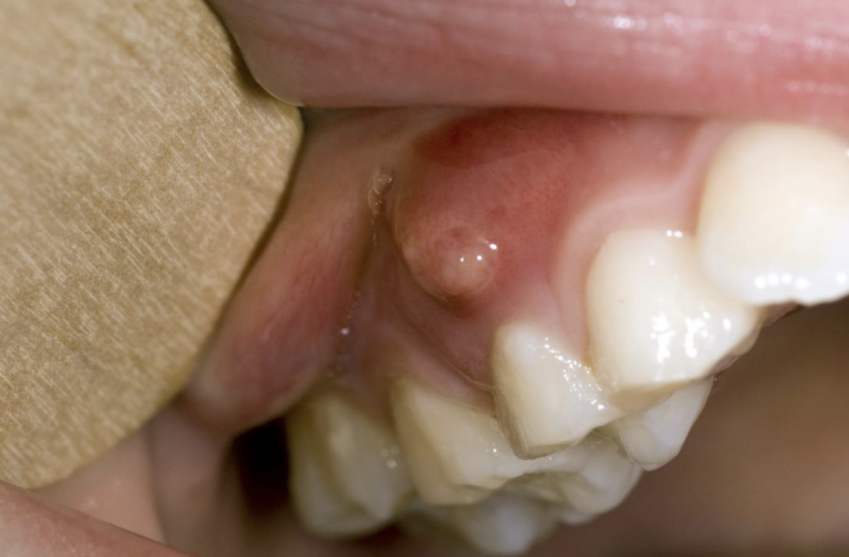 Scapă de puroi la măsea: Ce recomandă medicii stomatologi
