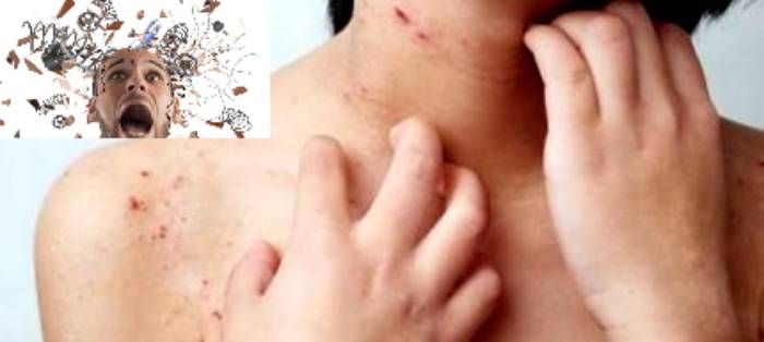 Alergii ale pielii pe sistem nervos: Cât de tare vă afectează stresul