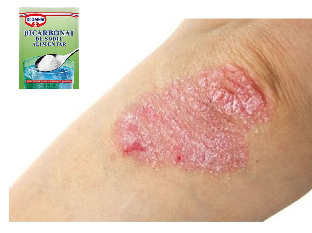 Bicarbonat pentru eczeme: Cum să scapi ușor de dermatită