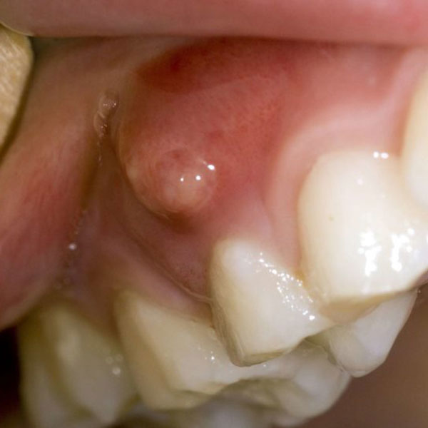 Pungă de puroi pe gingie: Tratament pentru abcesul gingival