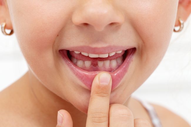 gura unui copil din care lipseste un dinte