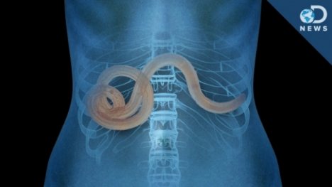 Viermi si paraziți intestinali – tipuri, simptome, tratament Preparate de paraziti viermi