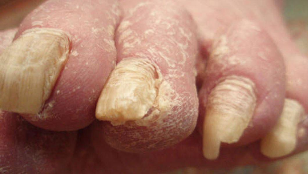 cum să dezinfectați unghiile pentru ciuperca unghiilor)