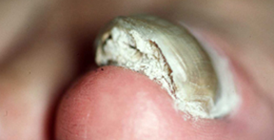 scăpa de oțetul de ciuperci ale unghiilor de la picioare tratamentul ciupercilor pe unghii metode populare