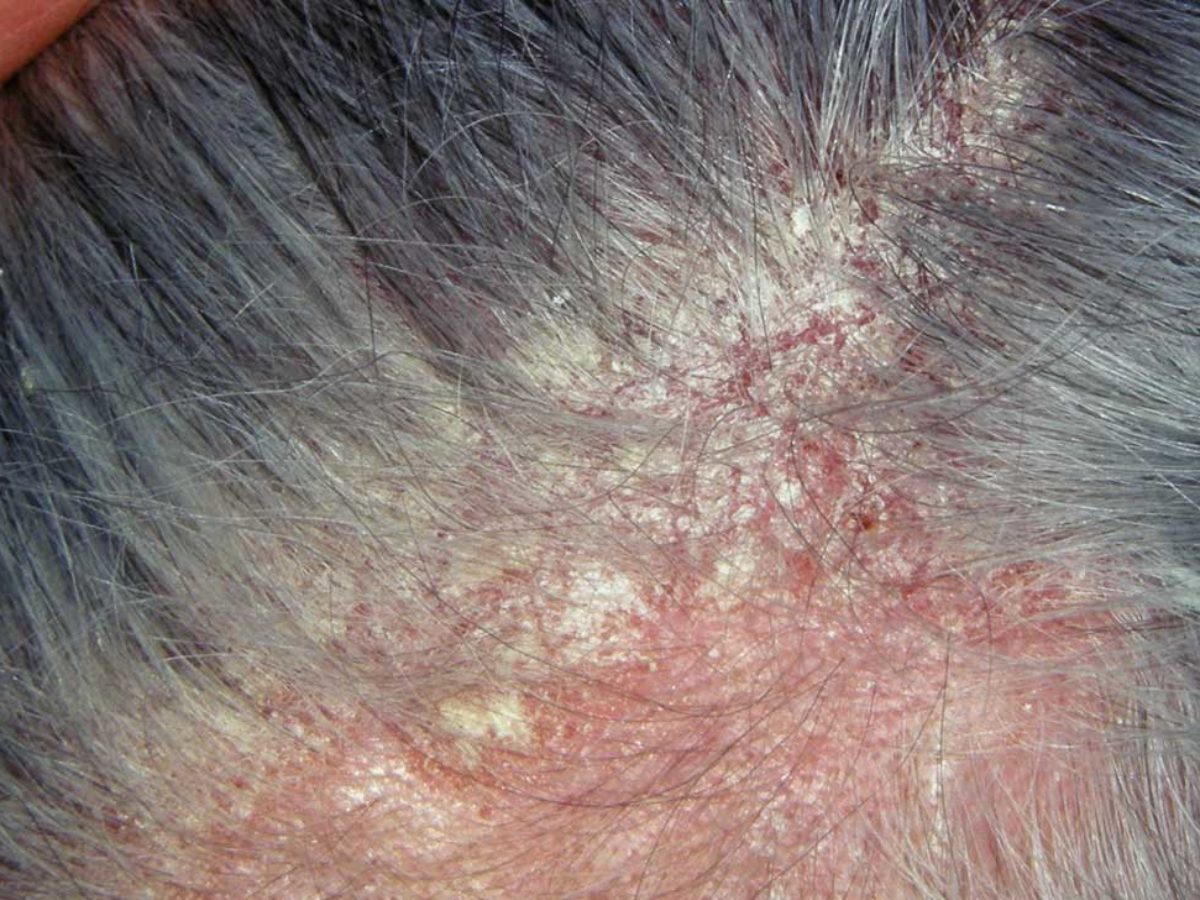 Șampon dermatită seboreică: Tratamentul care te scapă rapid de mătreață