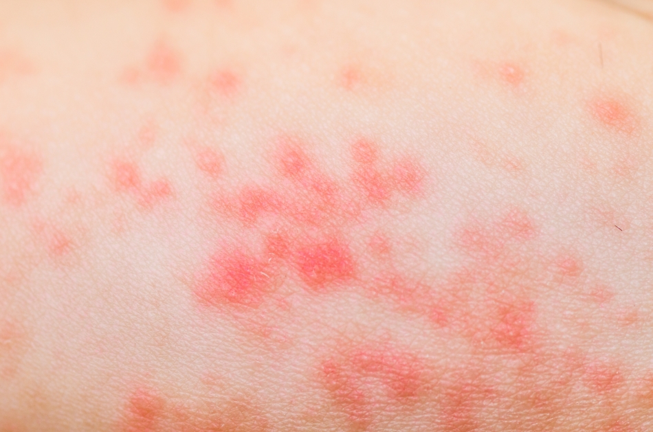 Toxiinfecție alimentară – bube: Cât de gravă este și cum se poate trata