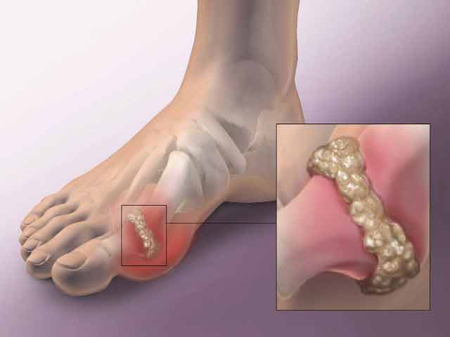 Acid uric crescut: Cum să ameliorezi simptomele gutei