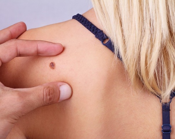 Alunițe cancerigene: Cât de gravă este situația și ce trebuie să faci