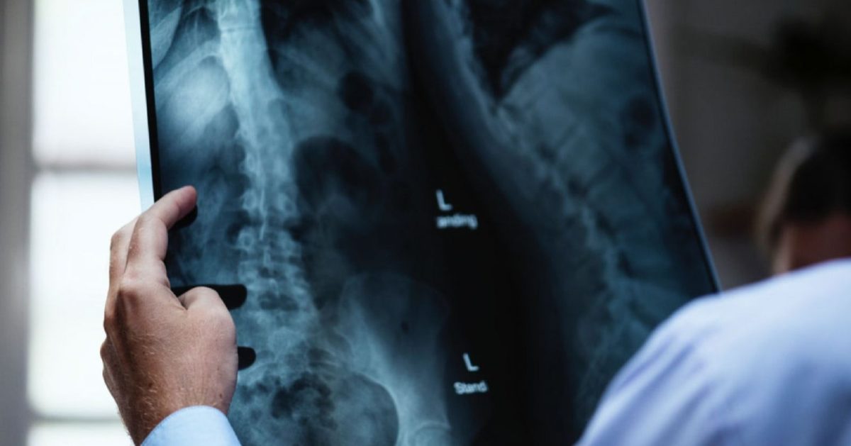 Restricții după operația de hernie de disc: Ce activități sunt interzise
