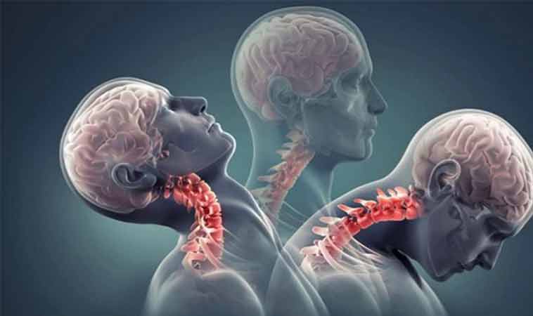 Tratament pentru spondiloza cervicală: Ce să faci dacă te confrunți cu amețeli