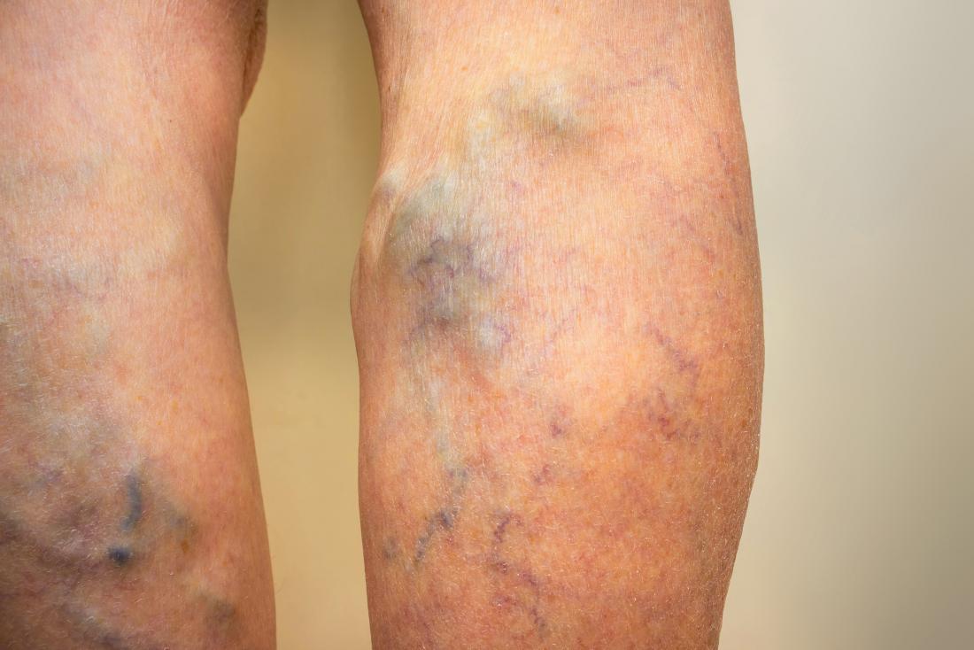 picioarele bolnave ale unui pacient