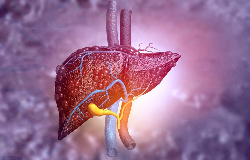 Steatoza hepatică alcoolică: Ce este, cum se manifestă și cum poate fi tratată