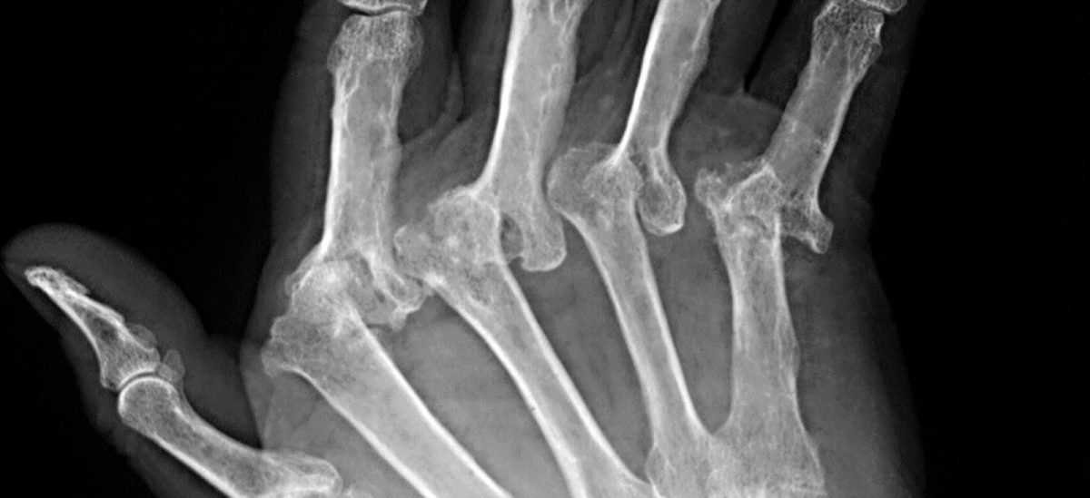 Ce este artrita psoriazică: Simptome și tratament