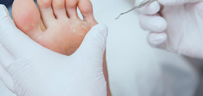 medic care administreaza un tratament pentru bataturile de pe picior a unei persoane