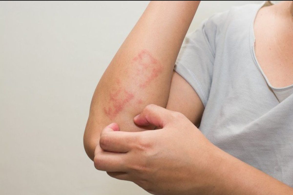 Cât timp trăiește scabia: Cum să ameliorezi rapid simptomele afecțiunii